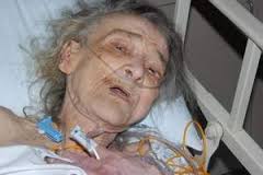 Fused but not at the hip